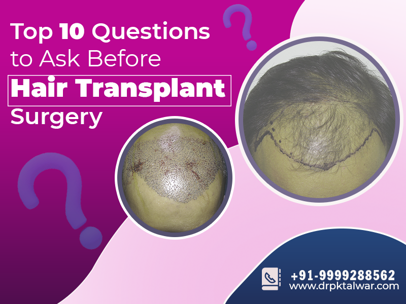 Top 10 Questions to Ask Before Hair Transplant Surgery