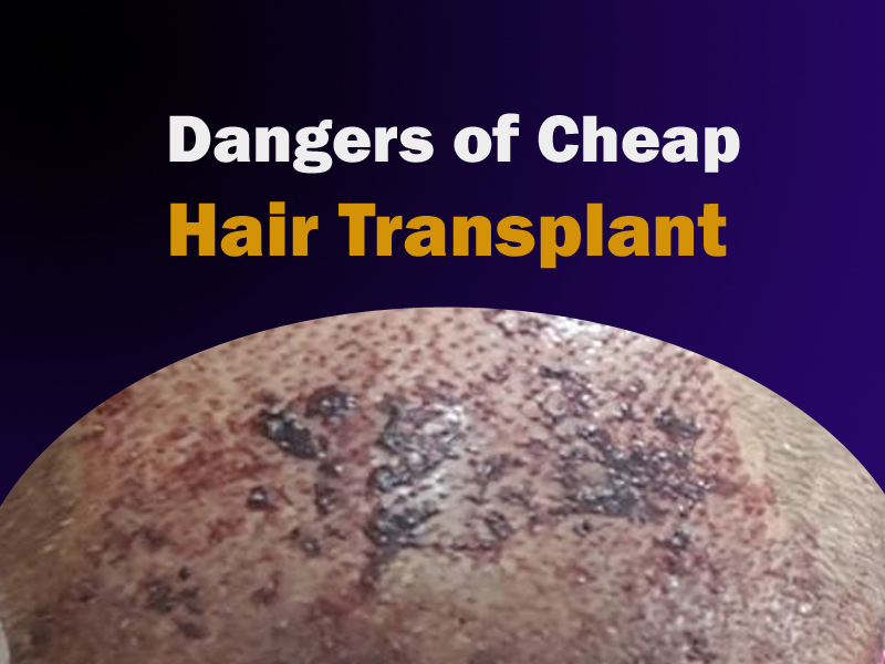 Dangers of Cheap Hair Transplant