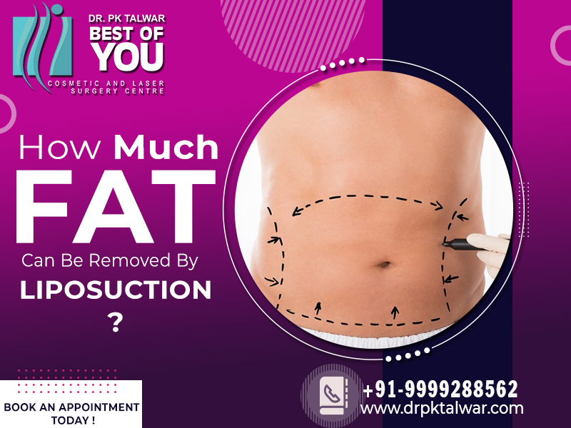 How Much Fat Can Be Removed by Liposuction?