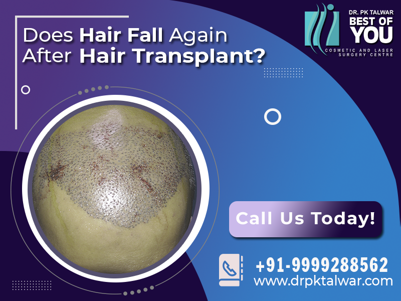 Does Hair Fall Again After Hair Transplant?