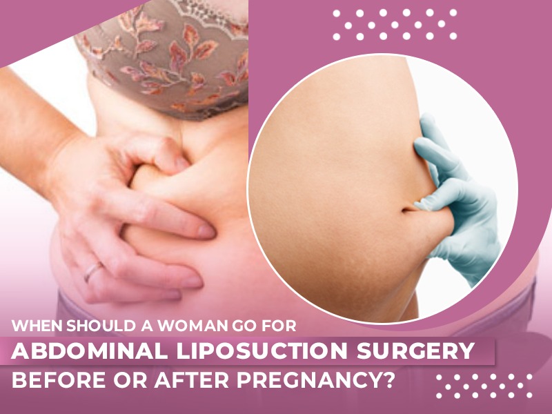 When Should A Woman Go For Abdominal Liposuction Surgery