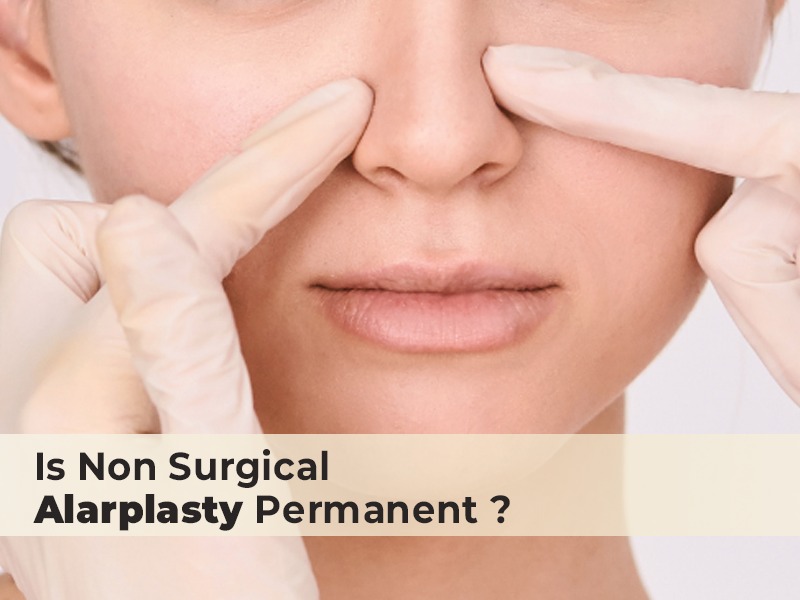 Is Non Surgical Alarplasty Permanent?