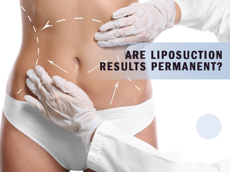 Are Liposuction Results Permanent? - Cosmetic Surgery Blogs