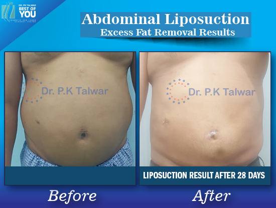 Non Surgical Fat Removal From Stomach