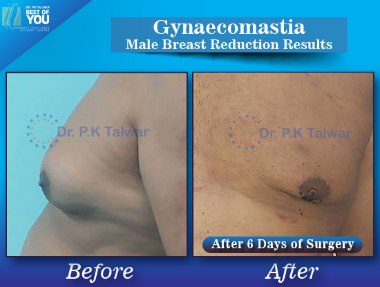 Male Breast(Gynaecomastia)Surgery in Delhi, Gynecomastia Cost in India